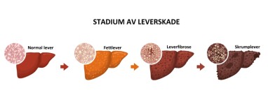 LEVERSKADE: Bildet illustrerer hvordan leveren ser ut i de forskjellige stadier av leverskade. Foto: NTB Scanpix/Shutterstock/Bildetekst oversatt av Lommelegen. LEVERSKADE: Bildet illustrerer hvordan leveren ser ut i de forskjellige stadier av leverskade. Foto: NTB Scanpix/Shutterstock/Bildetekst oversatt av Lommelegen.